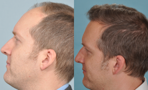 hair-transplant-before-and-after-picture-UK-patient-April-2013